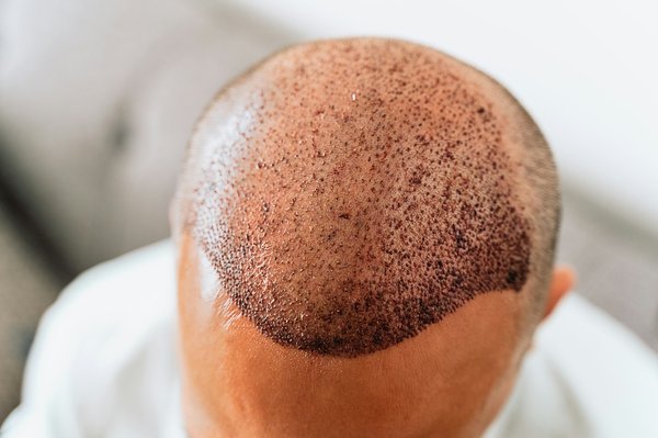 Transplantation de cheveux : quand en aurez-vous besoin ?